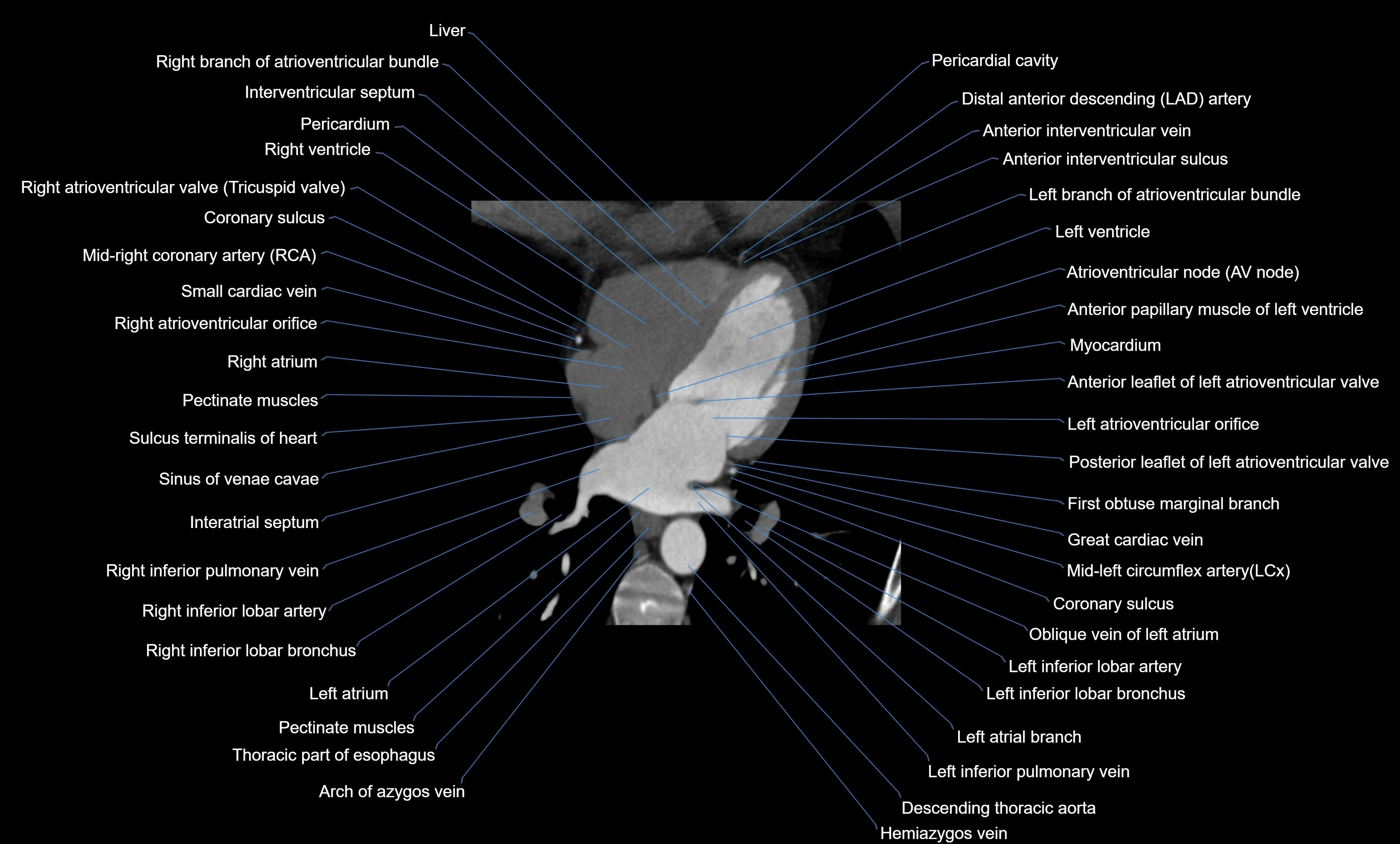 CT heart (coronary angiogram) four chamber view  cross sectional anatomy labelled radiology image -00032.webp